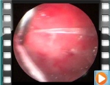 Thoracoscopy